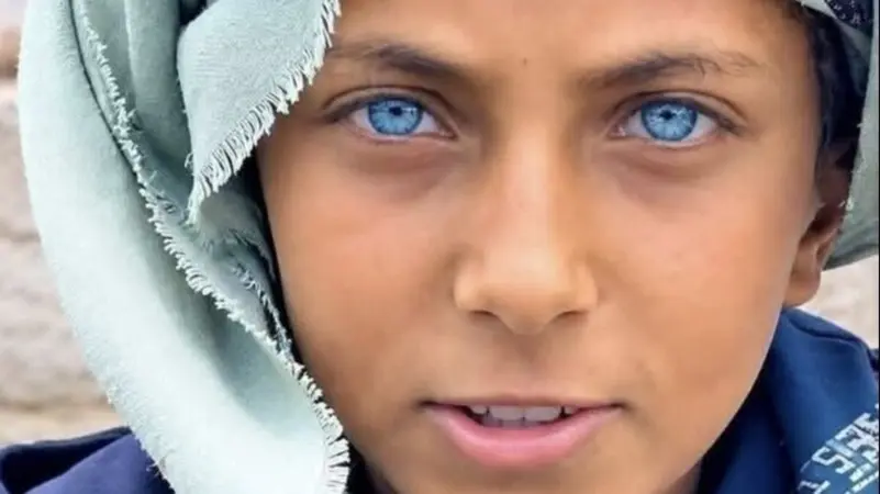 بعينين زرقاوين.. مراهق يمني يتحول إلى 